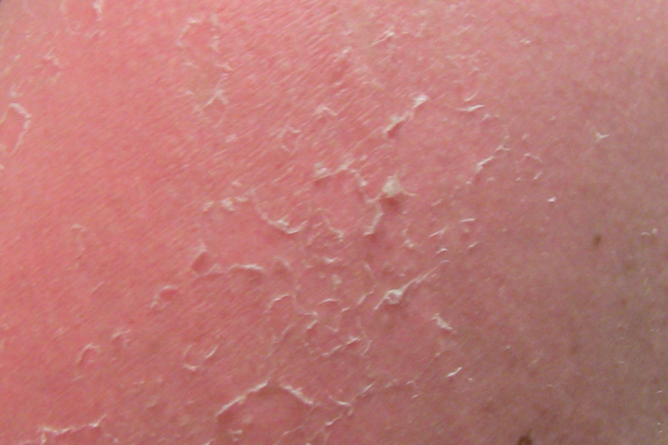 dry skin