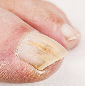 Nail Infection