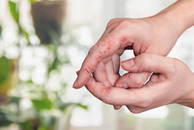 eczema
